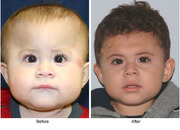Craniosynostosis Surgery- A treatment to cure abnormal shape of skull 