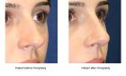  Rhinoplasty for improved facial symmetry