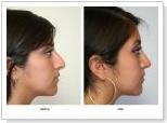 Rhinoplasty - Enhance Your Facial Harmony and Selfconfidence