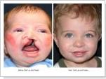 Cure Cleft Lip & Palate;  Regain your Infant's Beautiful Smile