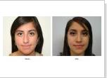 Right Option for Rhinoplasty in Houston